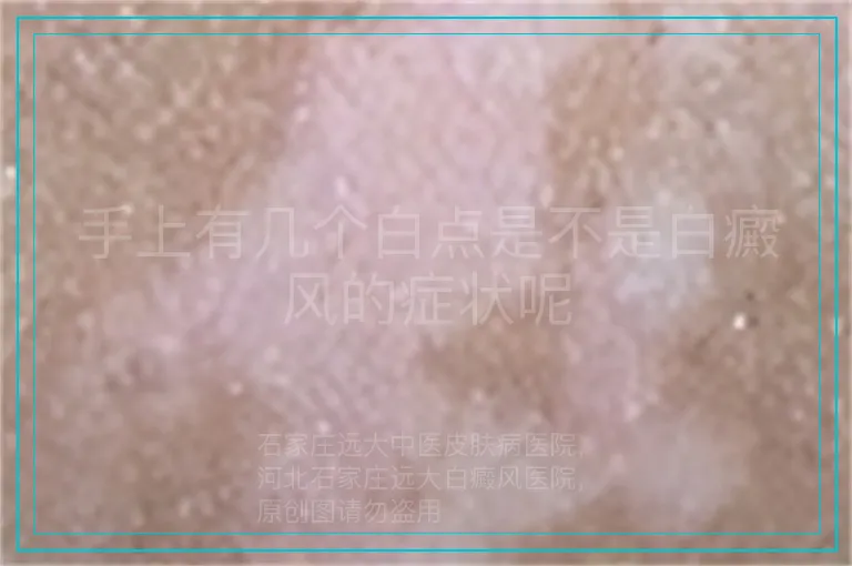 手上有几个白点是不是白癜风的症状呢