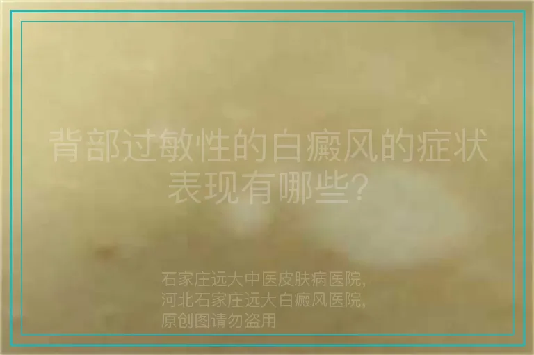 背部过敏性的白癜风的症状表现有哪些？
