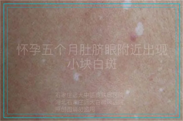 怀孕五个月肚脐眼附近出现小块白斑