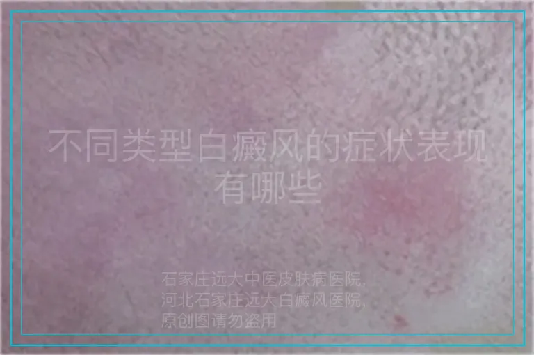 不同类型白癜风的症状表现有哪些