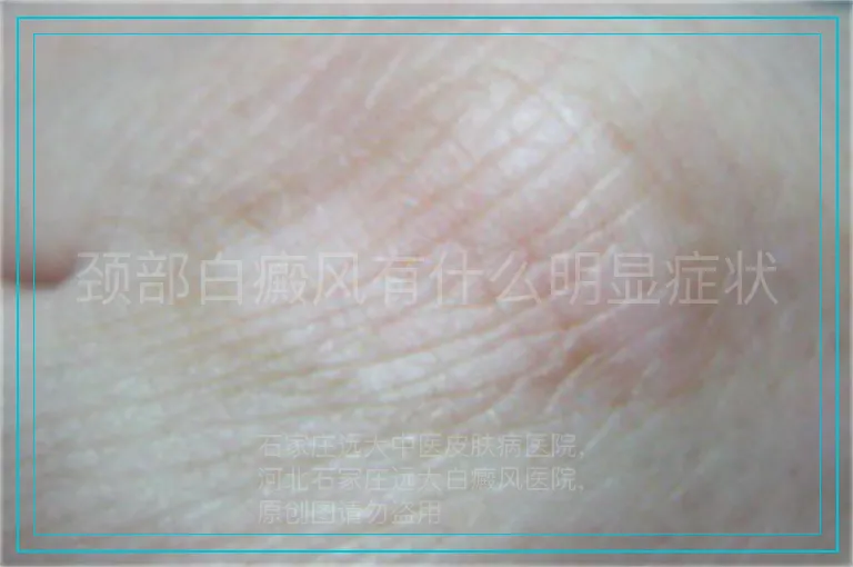 颈部白癜风有什么明显症状