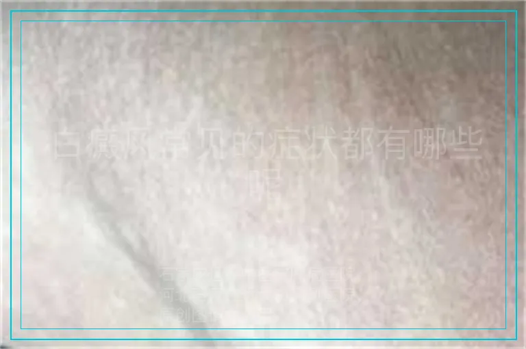 白癜风常见的症状都有哪些呢