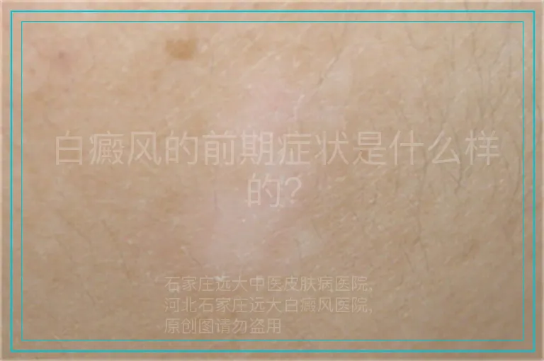 白癜风的前期症状是什么样的?