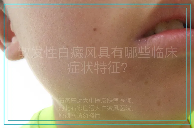 散发性白癜风具有哪些临床症状特征?
