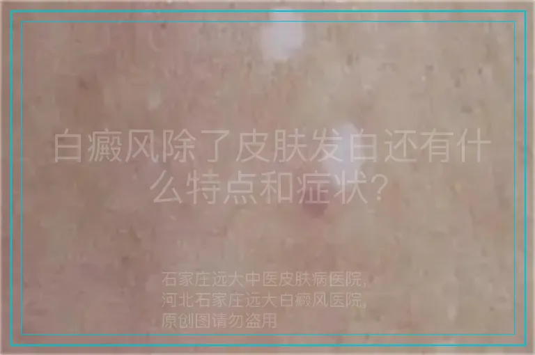 白癜风除了皮肤发白还有什么特点和症状?