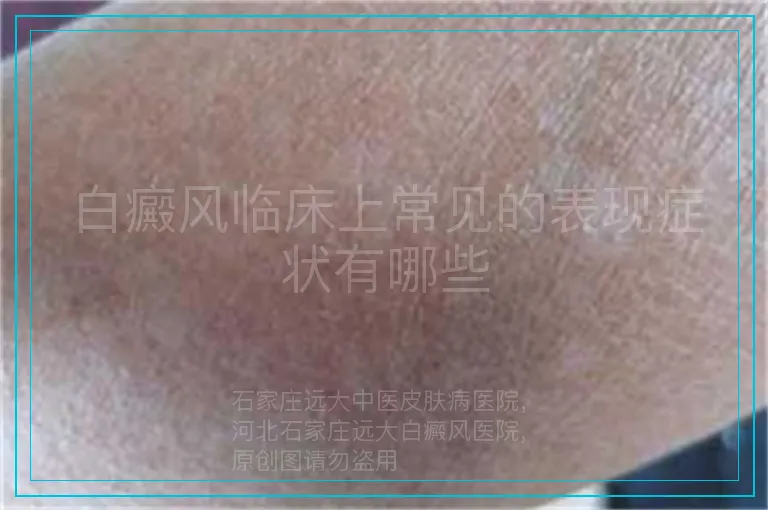 白癜风临床上常见的表现症状有哪些