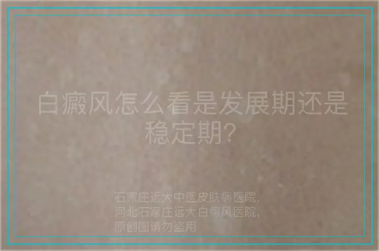 白癜风怎么看是发展期还是稳定期?