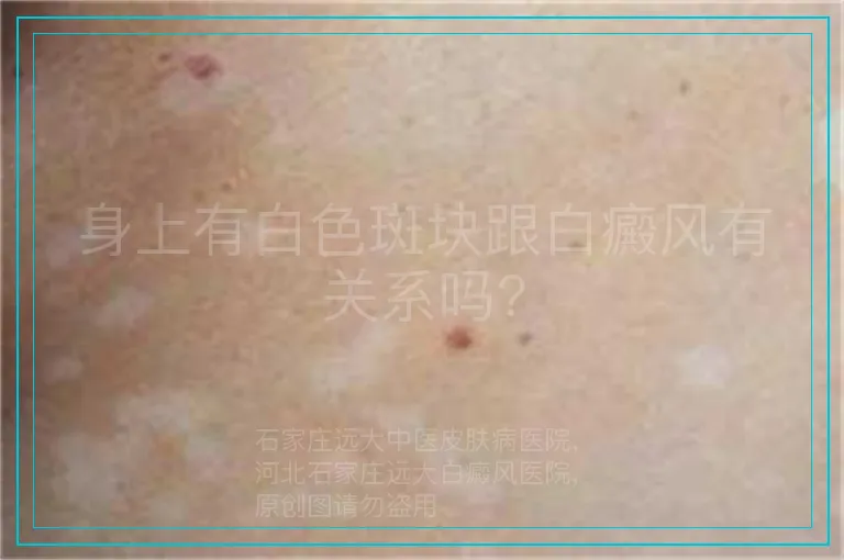 身上有白色斑块跟白癜风有关系吗?