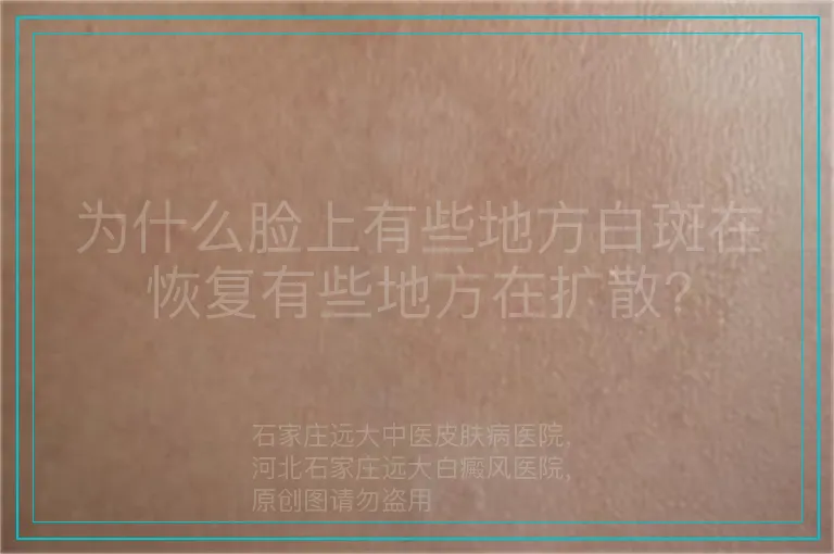 为什么脸上有些地方白斑在恢复有些地方在扩散?