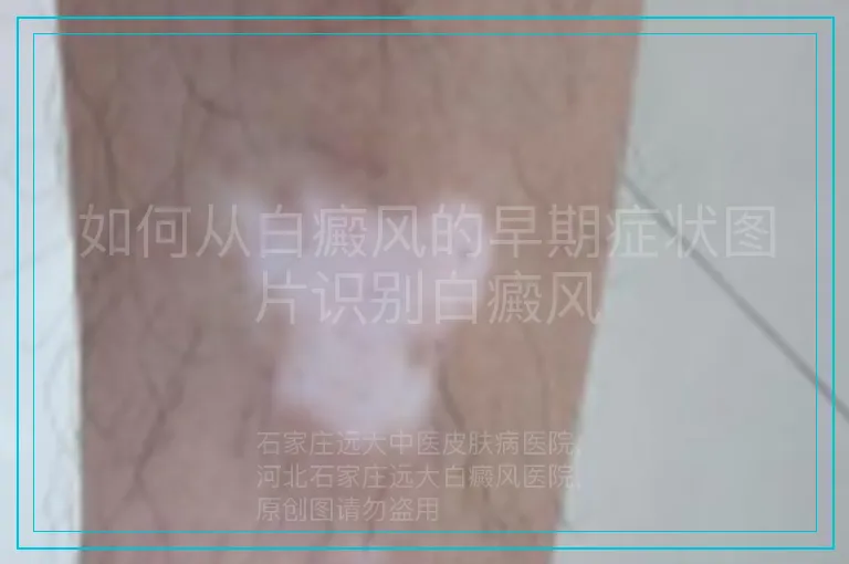 如何从白癜风的早期症状图片识别白癜风