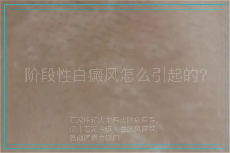 阶段性白癜风怎么引起的?
