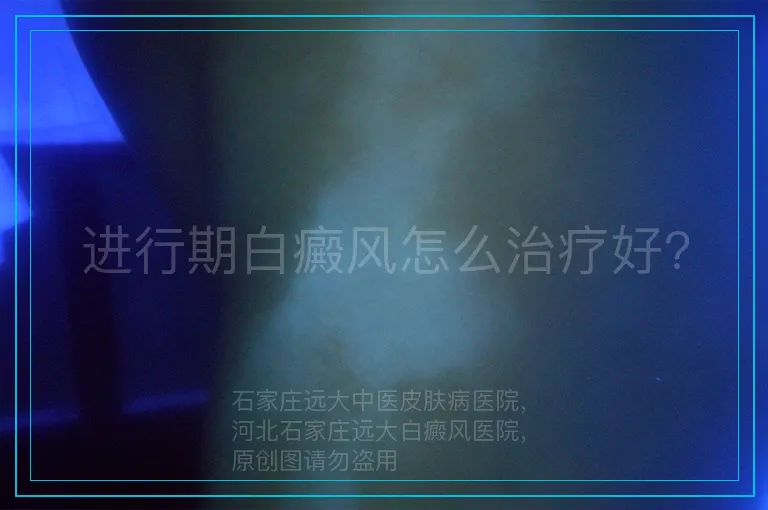 进行期白癜风怎么治疗好?