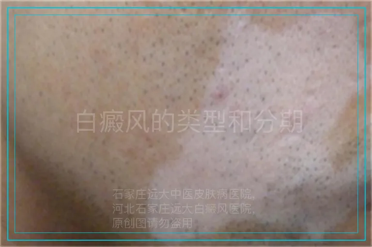 白癜风的类型和分期