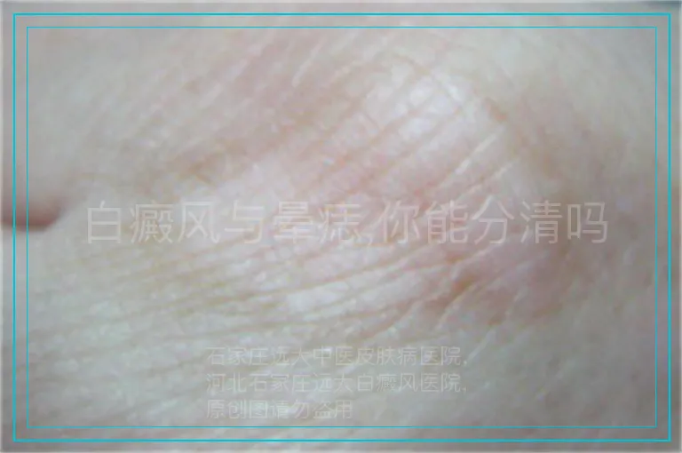 白癜风与晕痣,你能分清吗