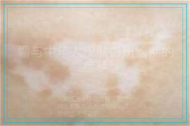 需与中年人皮肤白斑鉴别的症状