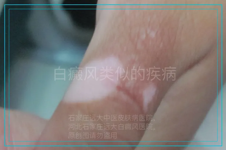 白癜风类似的疾病