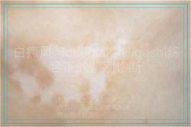 白癜风与chediak-Higashi综合征的鉴别诊断