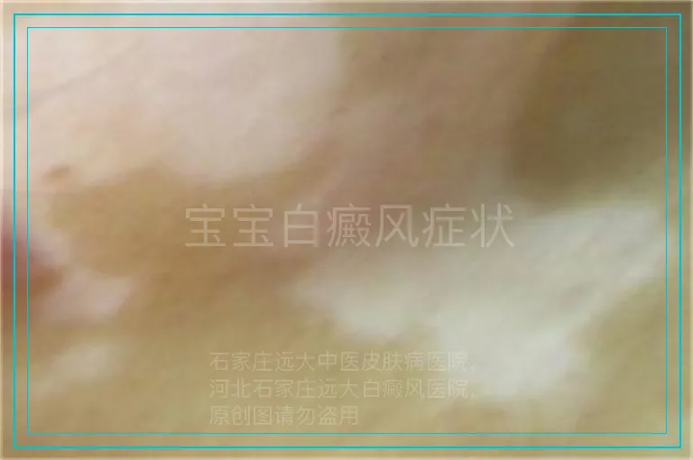宝宝白癜风症状