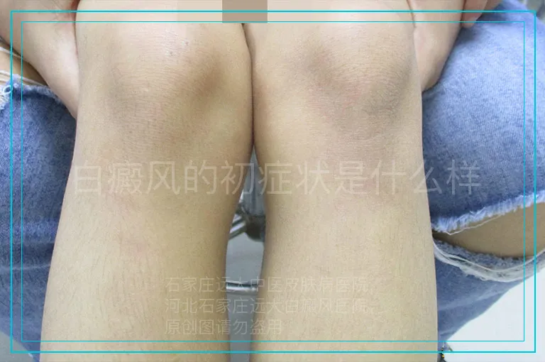 白癜风的初症状是什么样