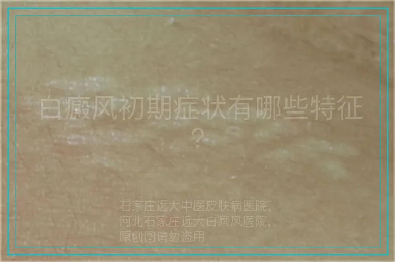 白癜风初期症状有哪些特征？