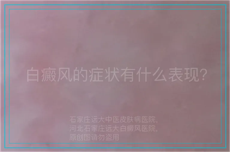 白癜风的症状有什么表现？