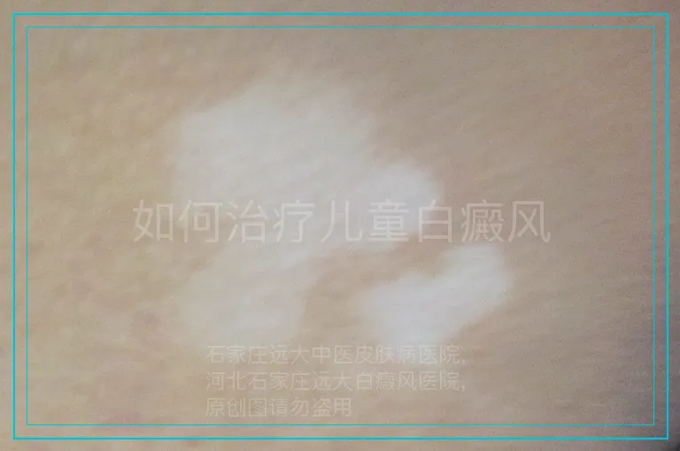 如何治疗儿童白癜风
