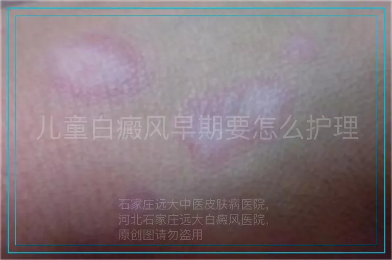 儿童白癜风早期要怎么护理