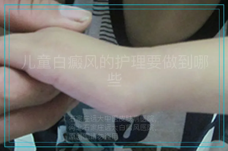 儿童白癜风的护理要做到哪些