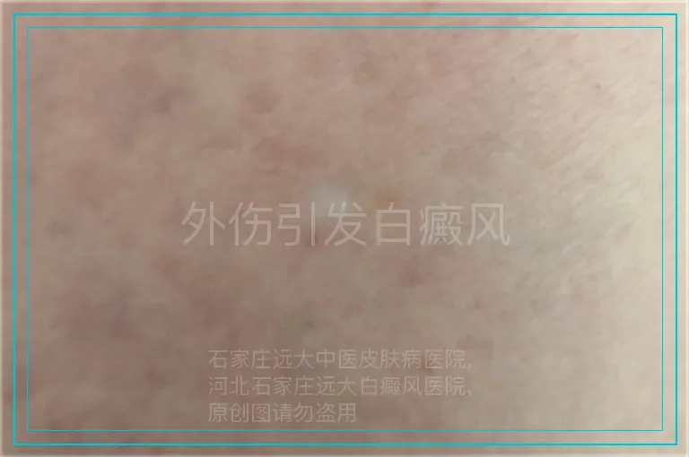 外伤引发白癜风