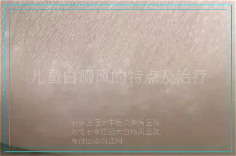 儿童白癜风的特点及治疗