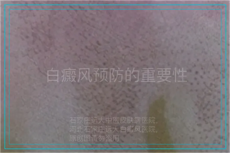 白癜风预防的重要性