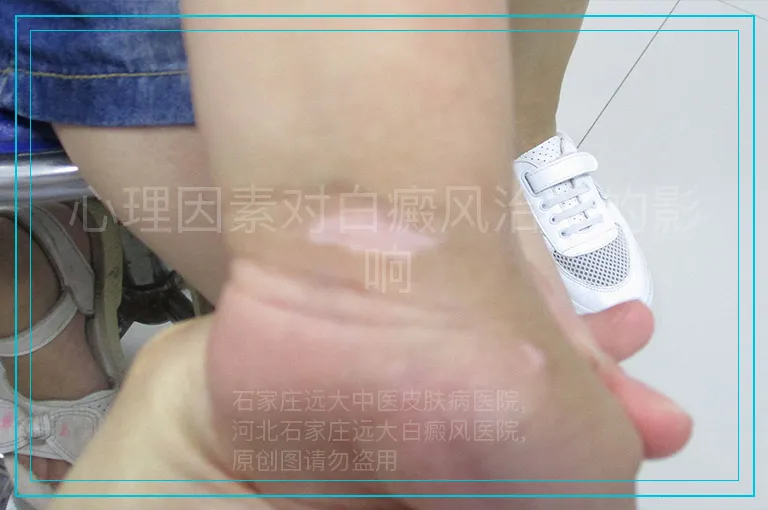心理因素对白癜风治疗的影响