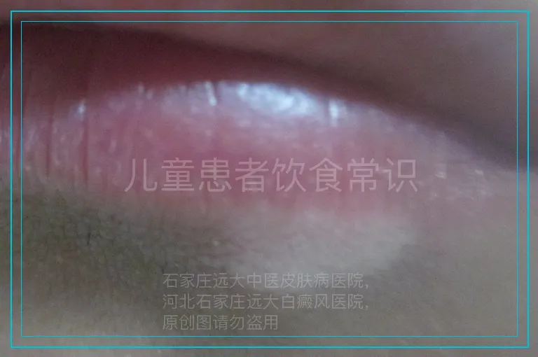 儿童患者饮食常识