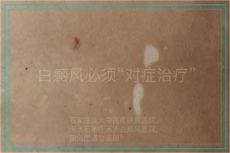 白癜风必须“对症治疗”