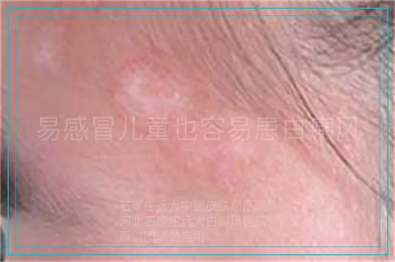 易感冒儿童也容易患白癜风