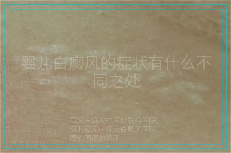婴儿白癜风的症状有什么不同之处