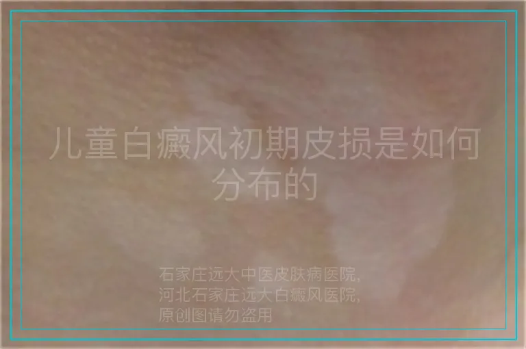 儿童白癜风初期皮损是如何分布的