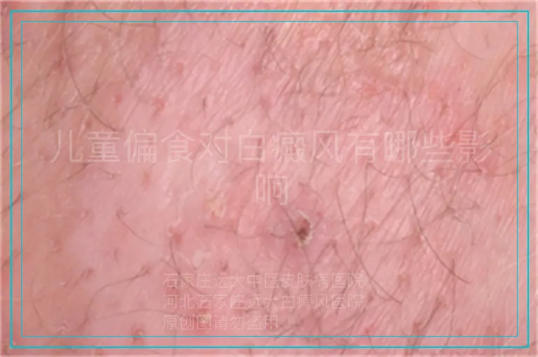 儿童偏食对白癜风有哪些影响