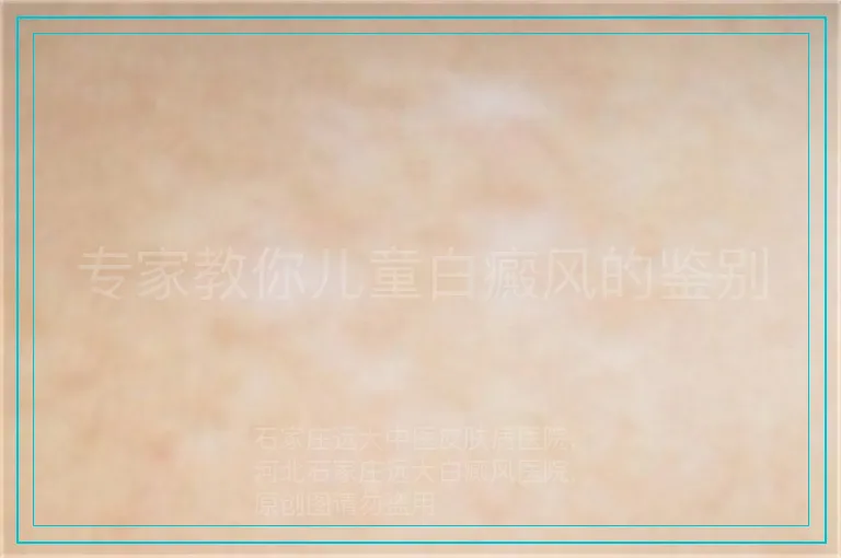 专家教你儿童白癜风的鉴别
