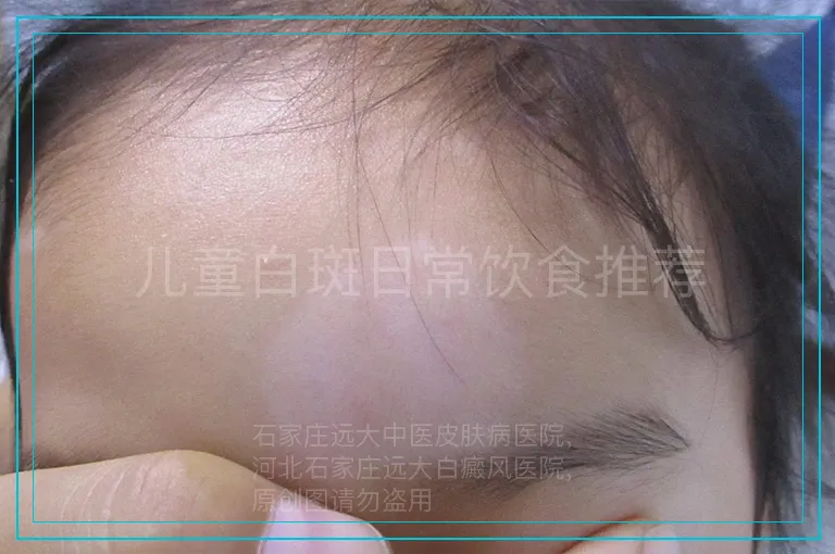 儿童白斑日常饮食推荐