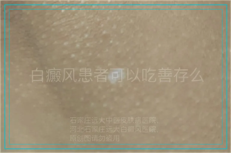 白癜风患者可以吃善存么