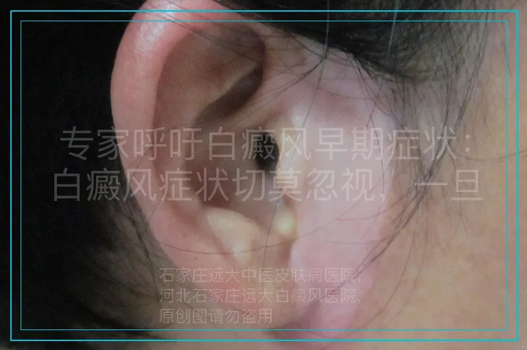 专家呼吁白癜风早期症状：白癜风症状切莫忽视，一旦出现要抓紧治疗