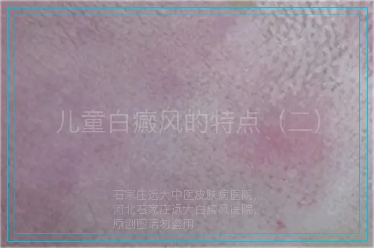 儿童白癜风的特点（二）