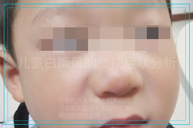 儿童白癜风的皮损症状分析