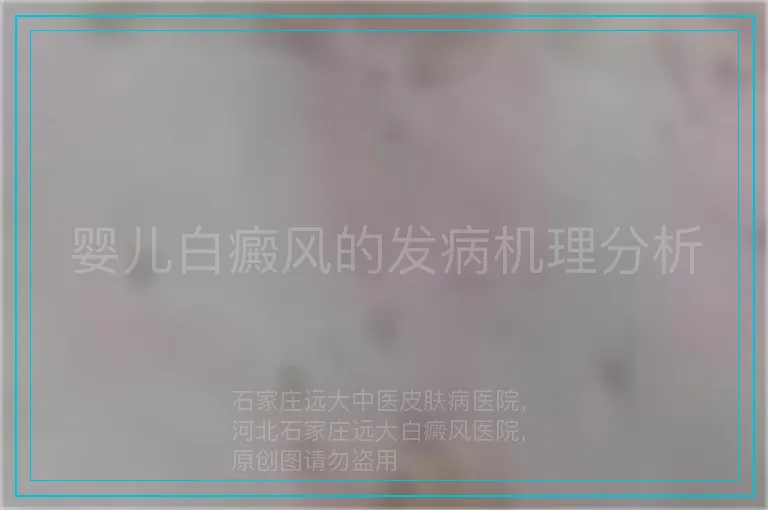 婴儿白癜风的发病机理分析