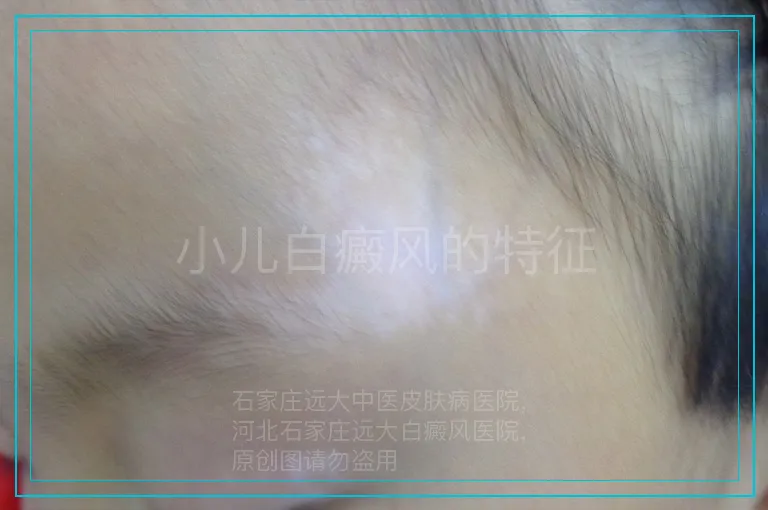 小儿白癜风的特征
