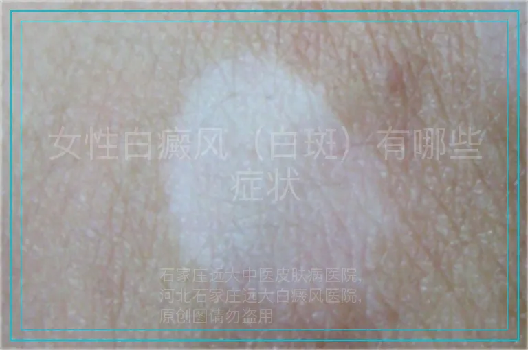 女性白癜风（白斑）有哪些症状