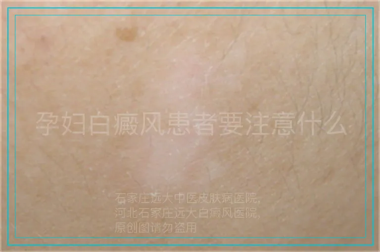 孕妇白癜风患者要注意什么