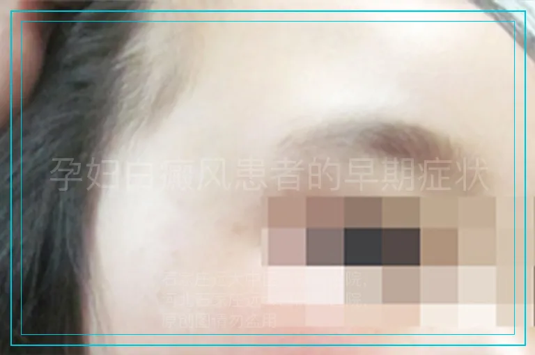 孕妇白癜风患者的早期症状