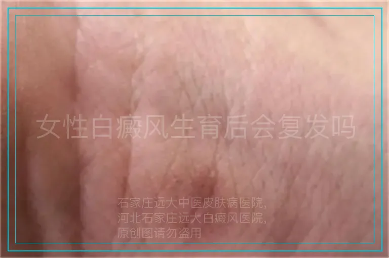 女性白癜风生育后会复发吗